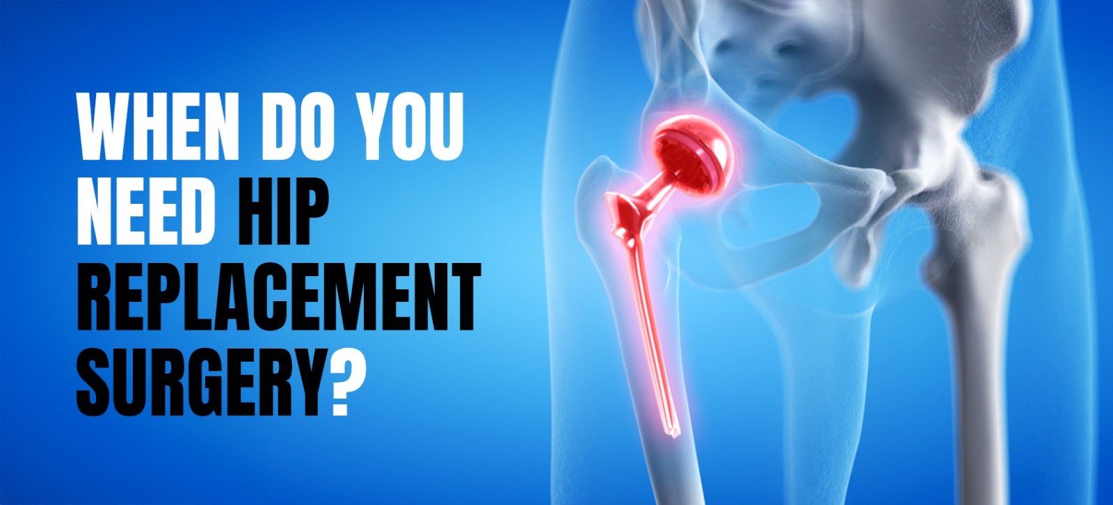 When Do You Need Hip Replacement Surgery?